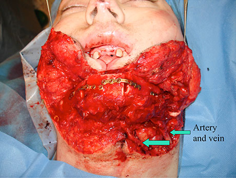 Figur 7. Pasient 3. Median skuddskade med tap av underkjeves korpusdel rekonstruert med fritt mikrovaskulært fibulatransplantat.